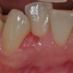 Gengivite gravidica al 3° mese di gravidanza - dentista a Bologna - Ambulatorio Prof. Checchi