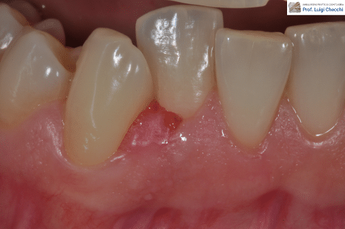 Gengivite gravidica al 3° mese di gravidanza - dentista a Bologna - Ambulatorio Prof. Checchi