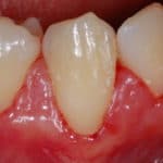 Gengive che sanguinano - dentista a Bologna - Ambulatorio Prof. Checchi