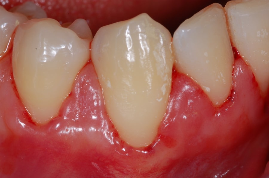 Gengive che sanguinano - dentista a Bologna - Ambulatorio Prof. Checchi