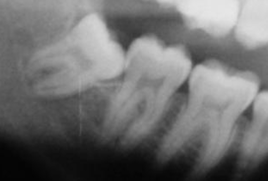 Dente del giudizio sul nervo mandibolare