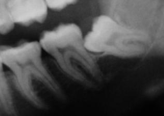 Dente del giudizio sul nervo mandibolare