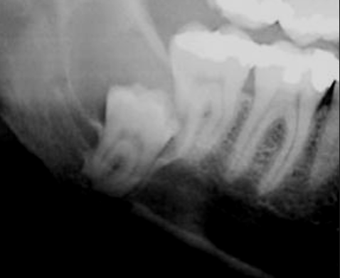 Dente del giudizio sul nervo mandibolare