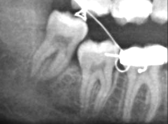 Dente del giudizio sul nervo mandibolare