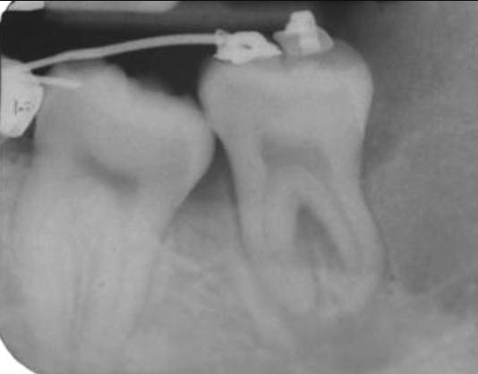 Dente del giudizio sul nervo mandibolare