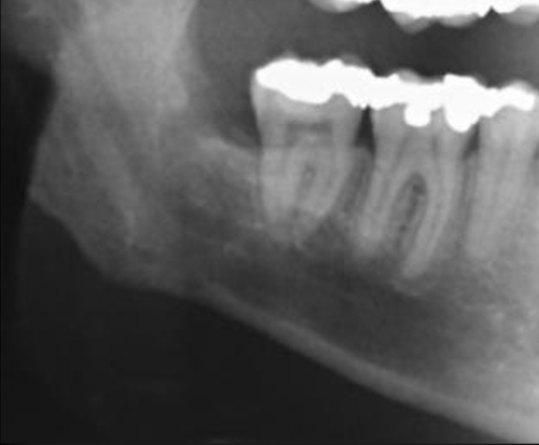 Dente del giudizio sul nervo mandibolare