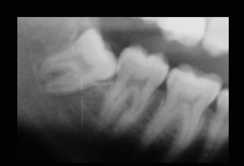 Ortodonzia estrattiva: il dente del giudizio viene allontanato con tecnica ortodontica dal nervo alveolare inferiore