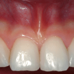 Gengive Sane e denti Belli Studio Checchi Bologna