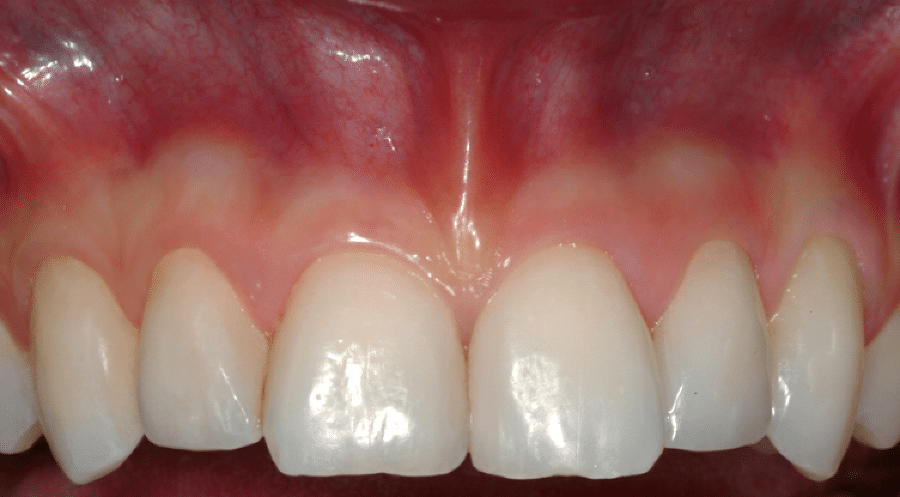 Gengive Sane e denti Belli Studio Checchi Bologna