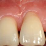 Recessione gengivale in paziente adulto