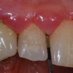 Placca batterica, sonda parodontale nella tasca, malattia parodontale o piorrea.