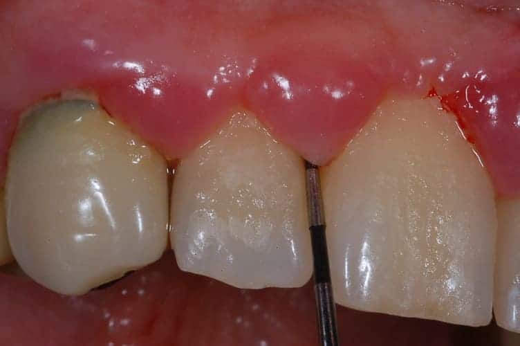 Placca batterica, sonda parodontale nella tasca, malattia parodontale o piorrea.