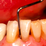 Misurazione tramite sonda della tasca parodontale