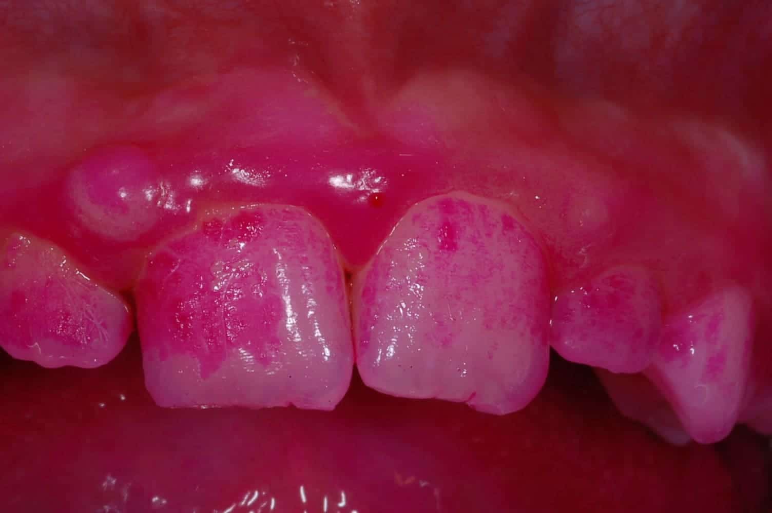 tecnica colorimetrica