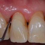 Sanguinamento gengivale