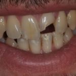 Frattura di un incisivo superiore a seguito di una gomitata durante partita di pallanuoto.