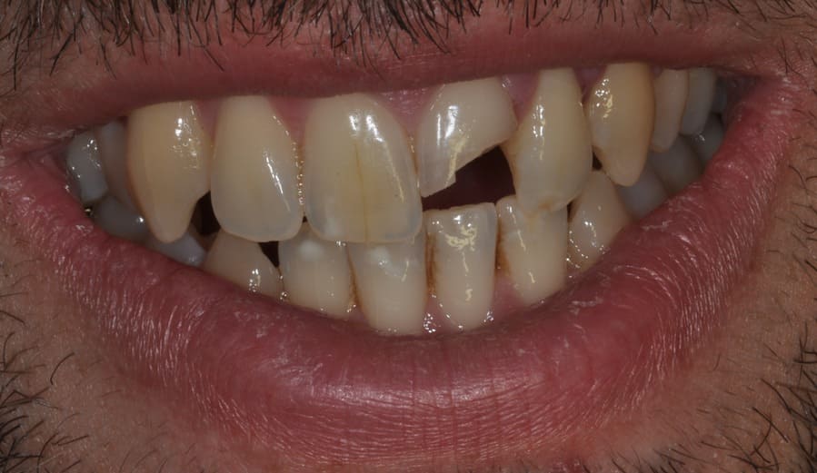 Frattura di un incisivo superiore a seguito di una gomitata durante partita di pallanuoto.