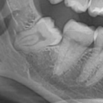 Disodontiasi del dente del giudizio