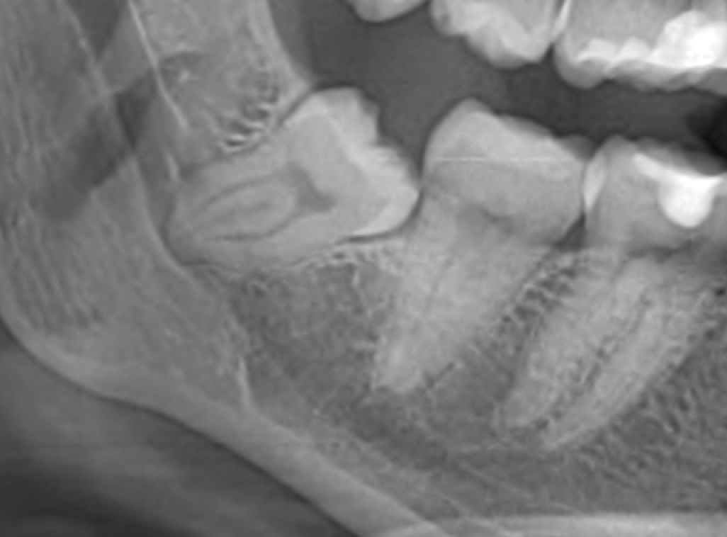 Disodontiasi del dente del giudizio