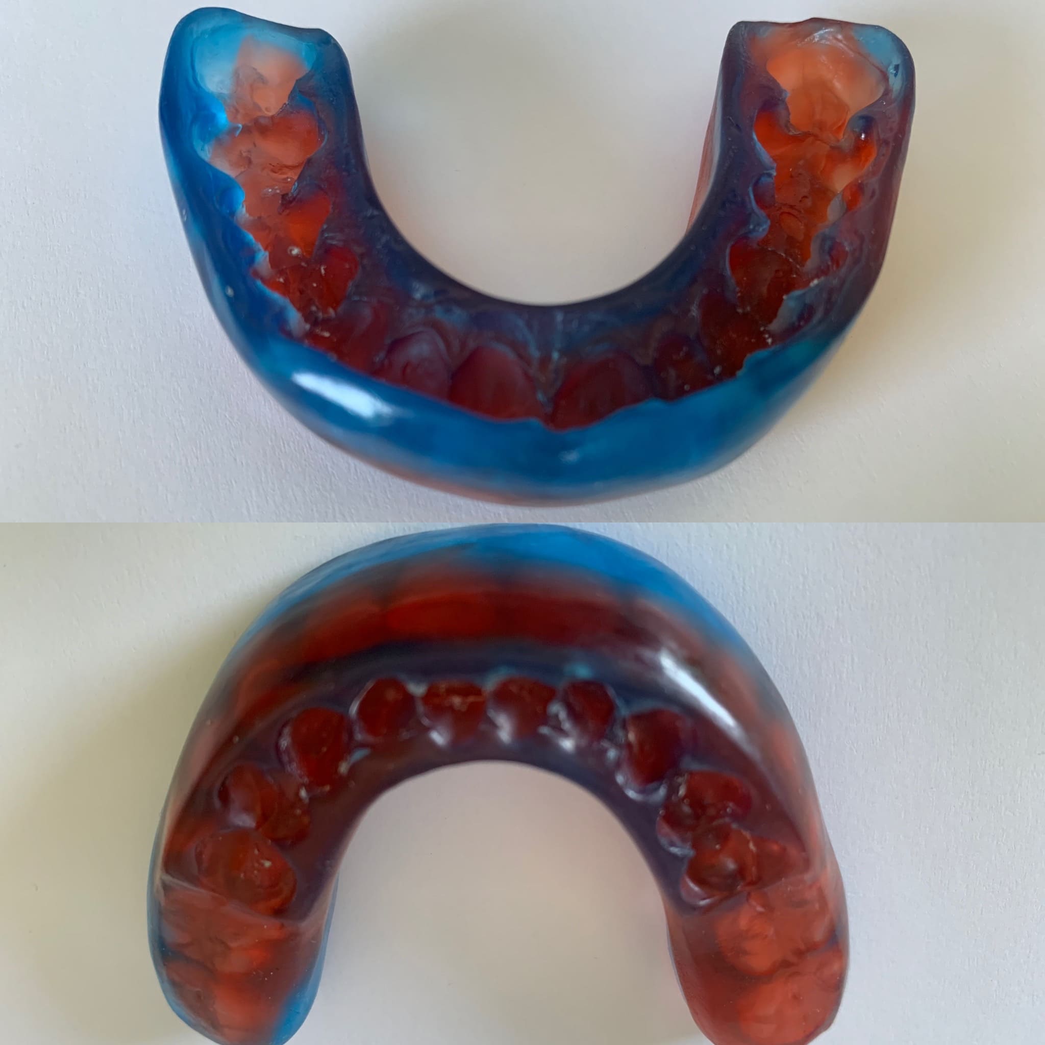 Paradenti o bite più complesso ancorato all'arcata superiore e inferiore, realizzato in silicone