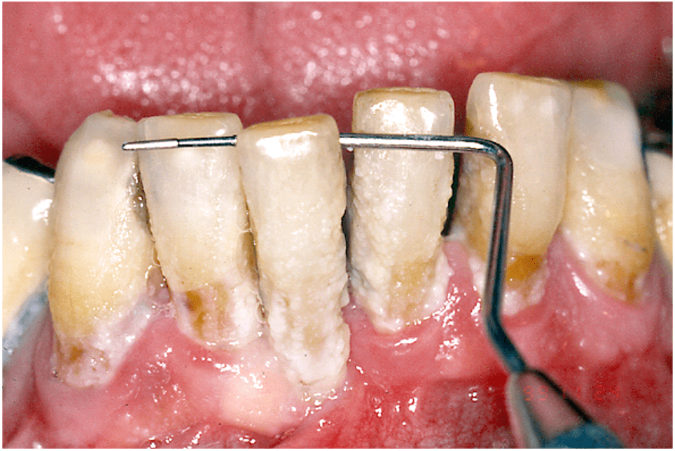 Piorrea e parodontite quadro avanzato