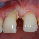 Piorrea-o-malattia-parodontale