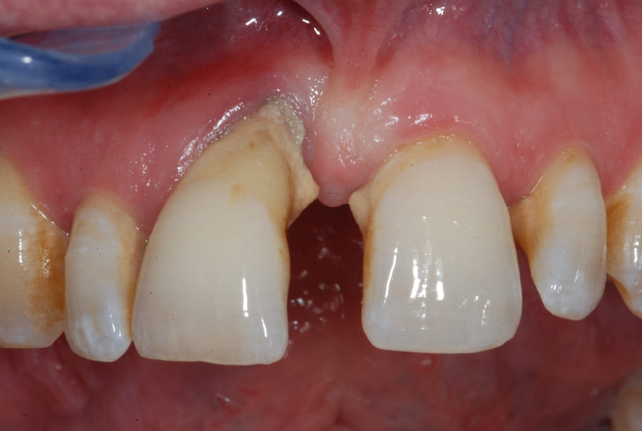 Piorrea-o-malattia-parodontale