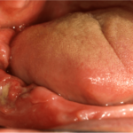 Batteri parodontopatici e cancro