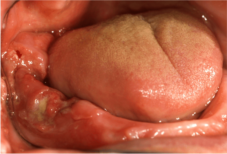 Batteri parodontopatici e cancro