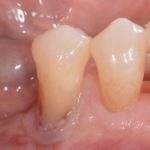 Placca Batterica Recessione gengivale