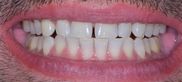 sbiancamento denti dopo