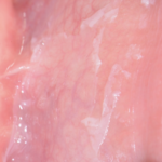 Reazione-allergica-da-collutorio-o-da-dentifricio