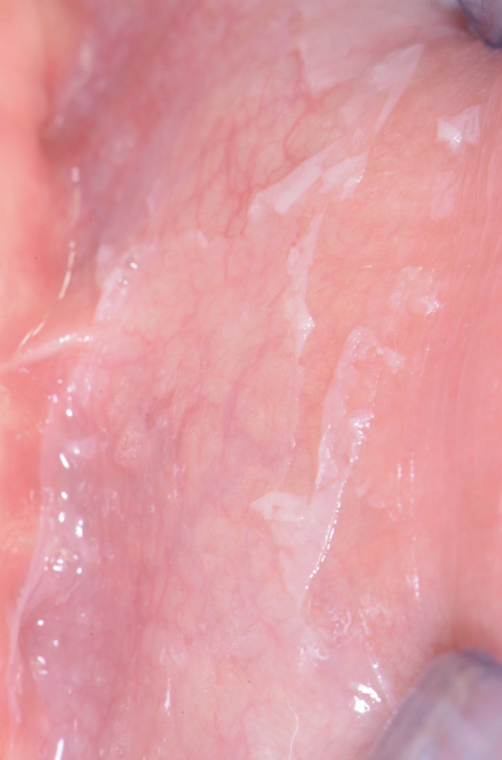 Reazione-allergica-da-collutorio-o-da-dentifricio