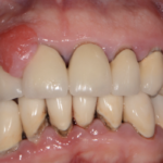 Epulide protesi fissa