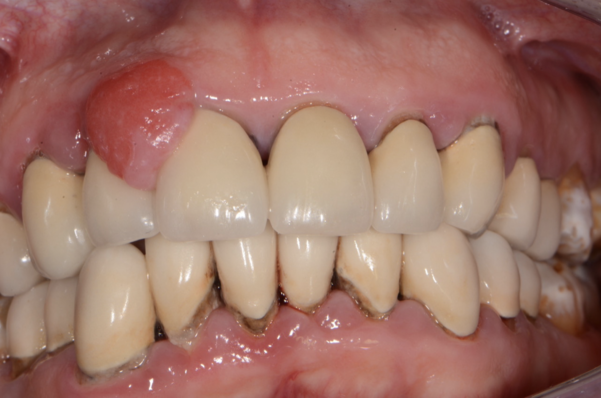 Epulide protesi fissa