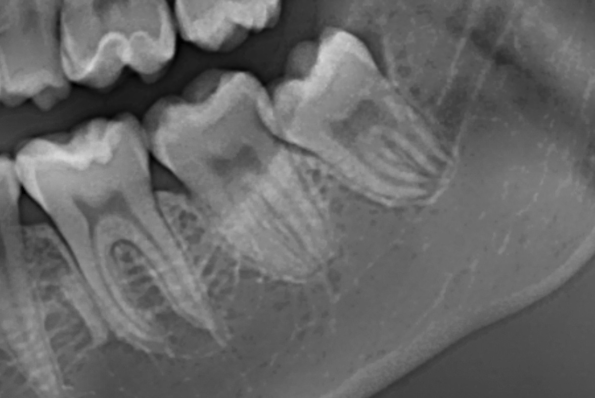 Terzo molare inferiore sinistro a contatto con il canale mandibolare