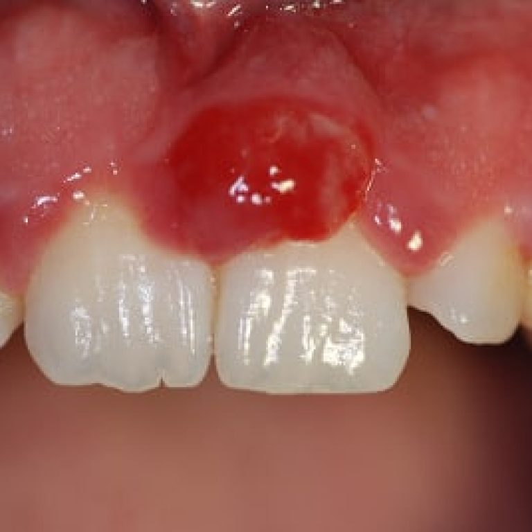 Epulide Prof. Luigi Checchi