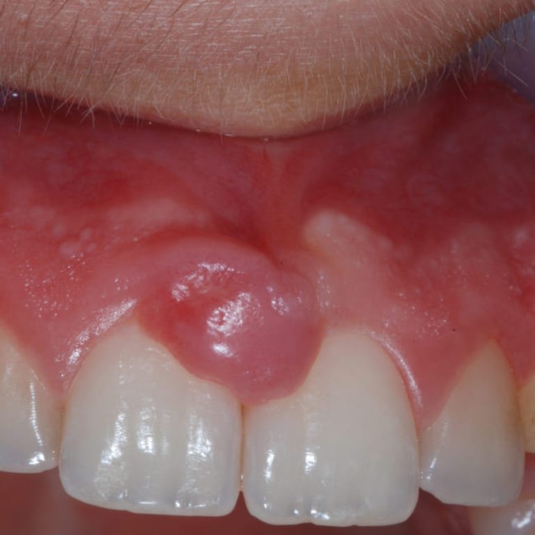 Epulide gengivale