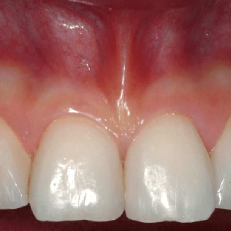 Gengive Sane e denti Belli Studio Checchi Bologna