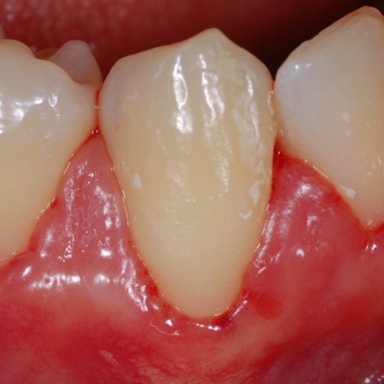 Gengive che sanguinano - dentista a Bologna - Ambulatorio Prof. Checchi
