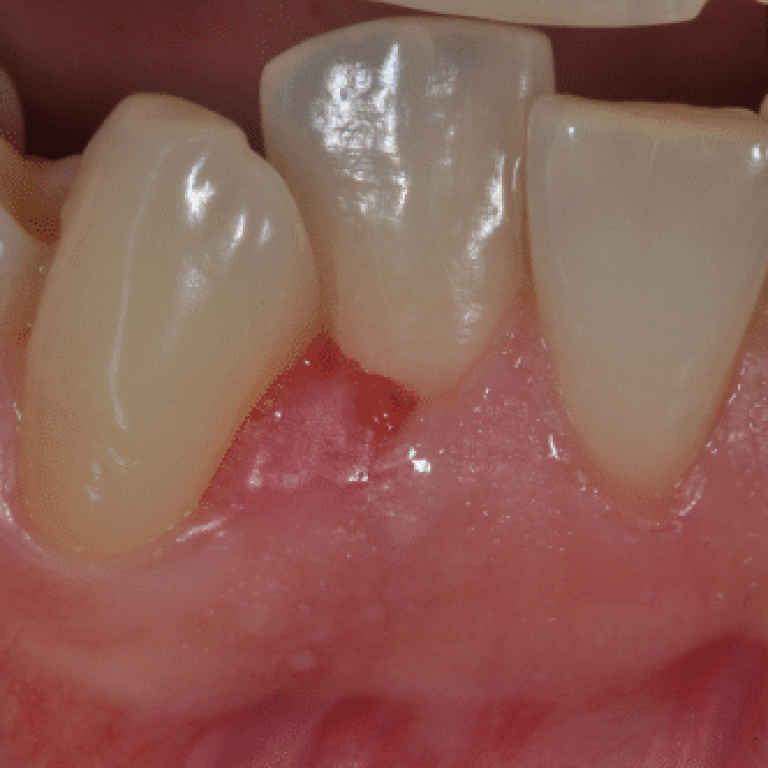 Gengivite gravidica al 3° mese di gravidanza - dentista a Bologna - Ambulatorio Prof. Checchi