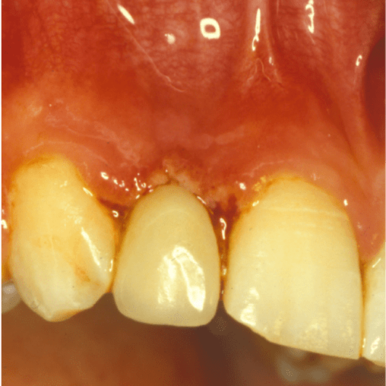 Gengivite ulcero necrotica