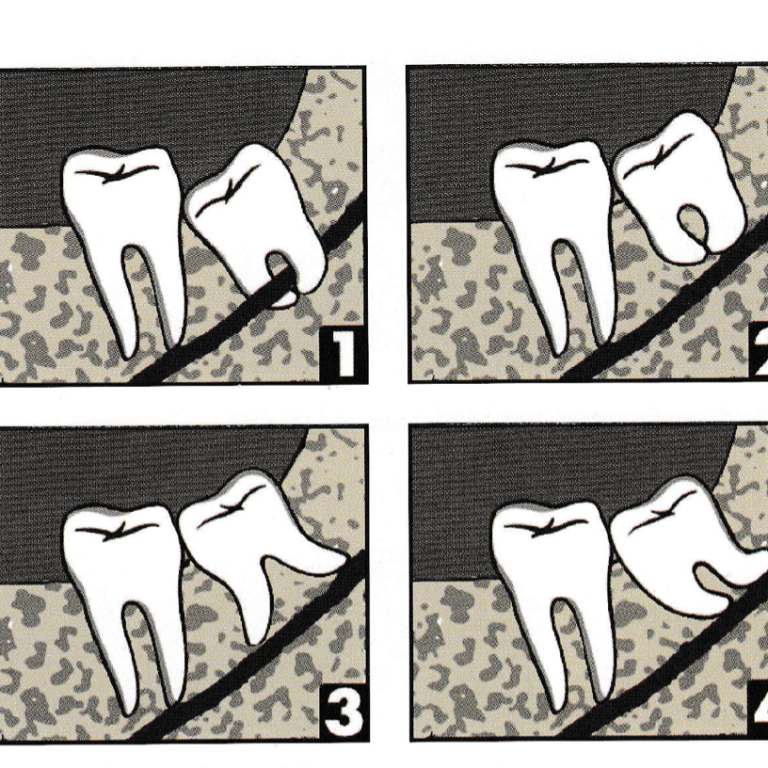 Il dente del giudizio inferiore