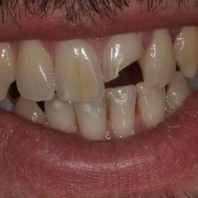 Frattura di un incisivo superiore a seguito di una gomitata durante partita di pallanuoto.