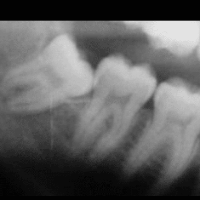 Ortodonzia estrattiva: il dente del giudizio viene allontanato con tecnica ortodontica dal nervo alveolare inferiore