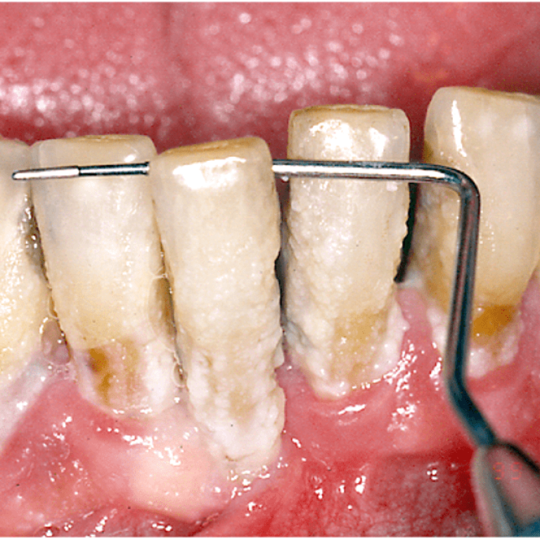 Piorrea e parodontite quadro avanzato