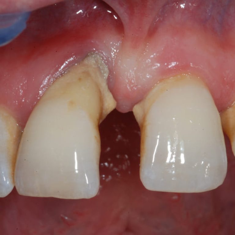 Piorrea-o-malattia-parodontale