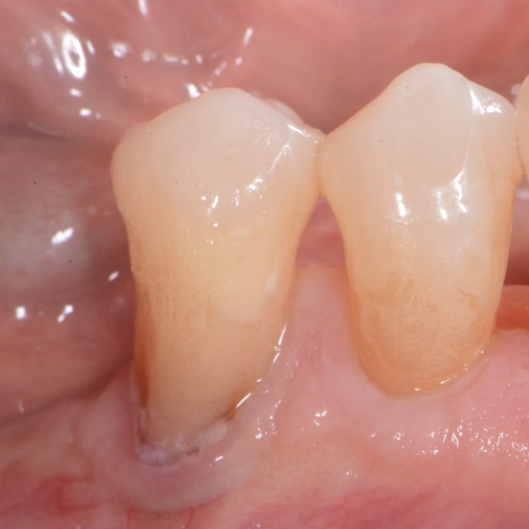 Placca Batterica Recessione gengivale