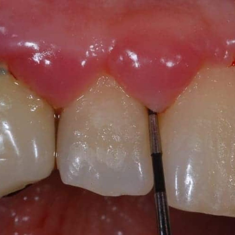 Placca batterica, sonda parodontale nella tasca, malattia parodontale o piorrea.