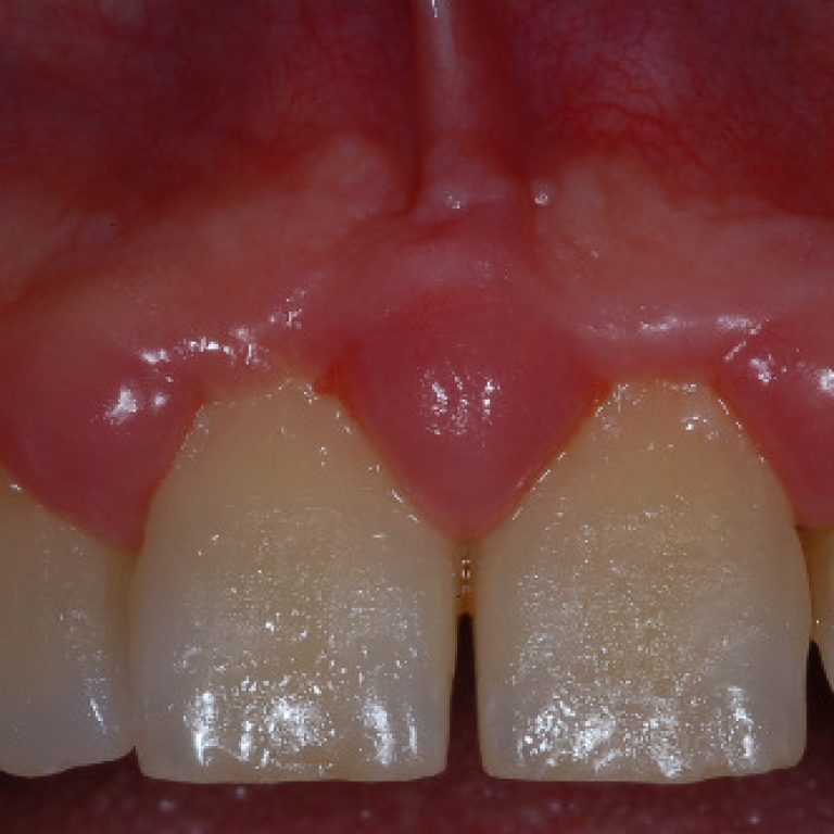 placca batteria - piorrea